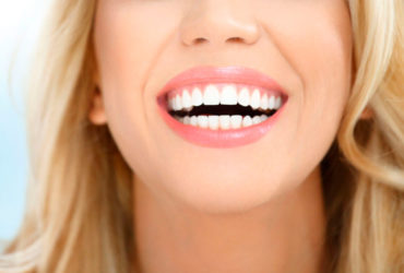 Odontología Estética: Carillas