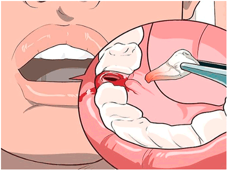 Manejo de la hemorragia postextracción